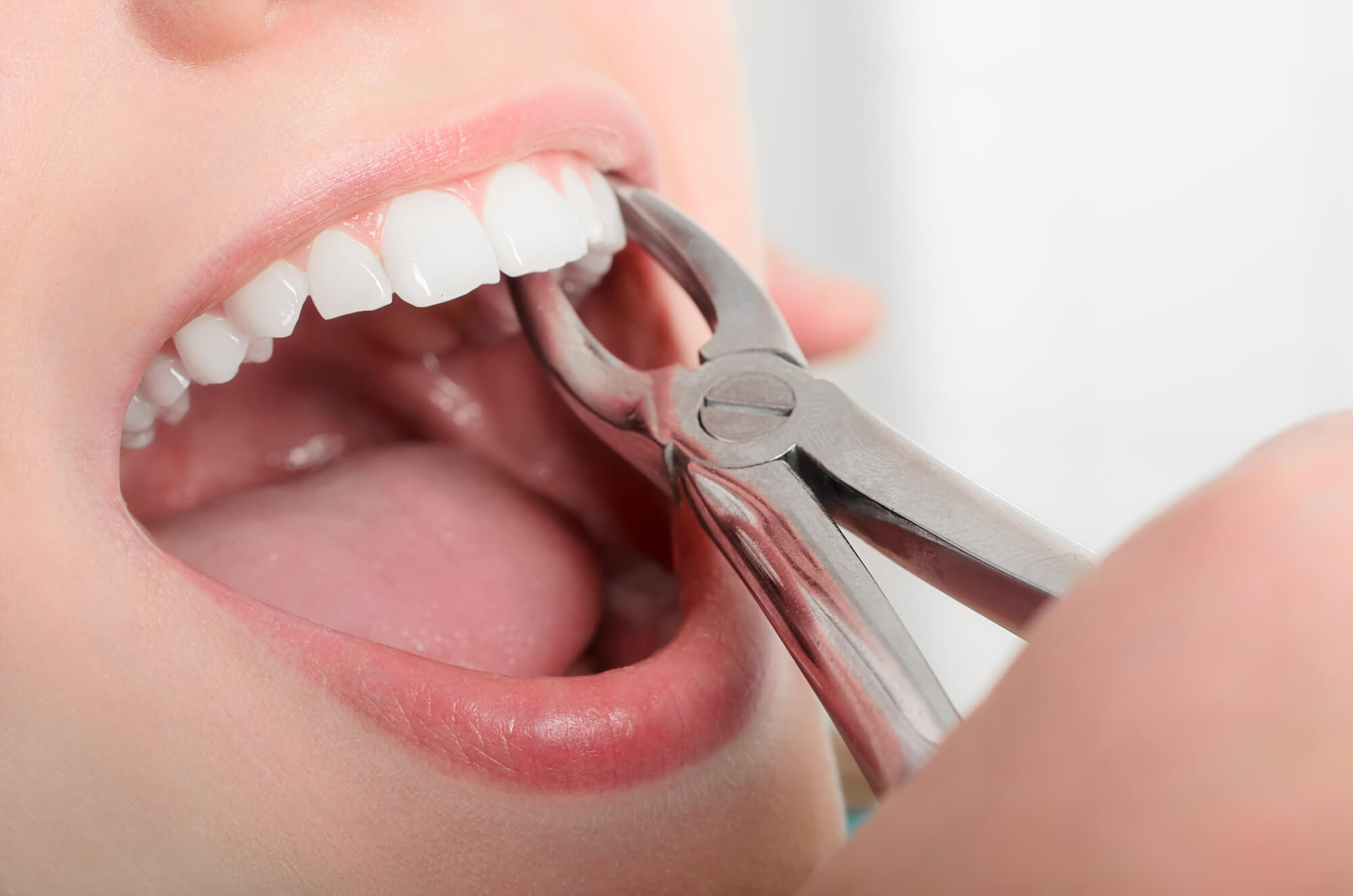 teeth Extraction whitening