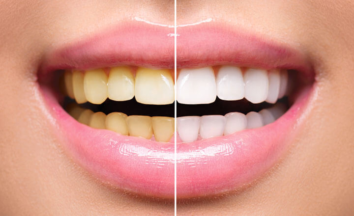 dentist bleaching whitening